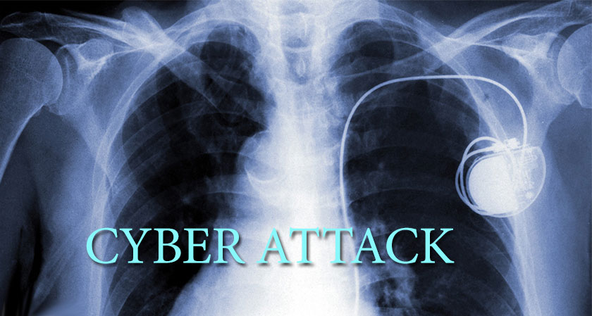 Pacemakers under cyber attack