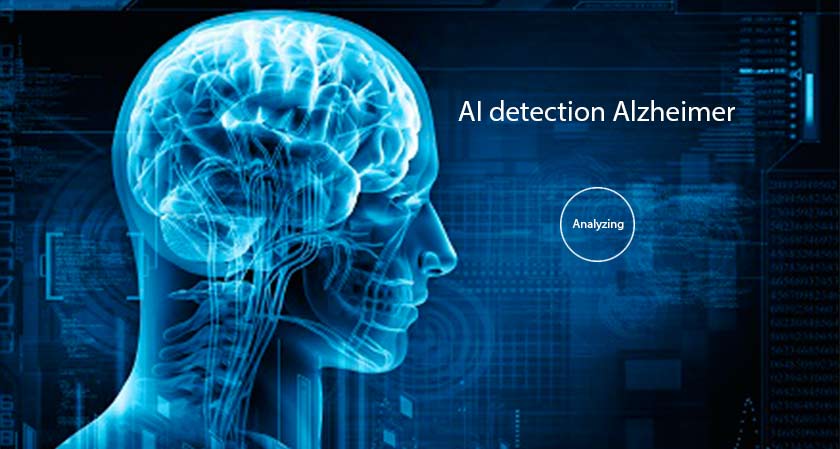 Researchers Train AI to Spot Alzheimer Disease