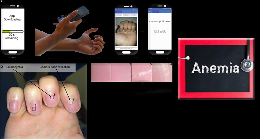  New Smartphone App That Can Detect Anaemia through Fingernails 
