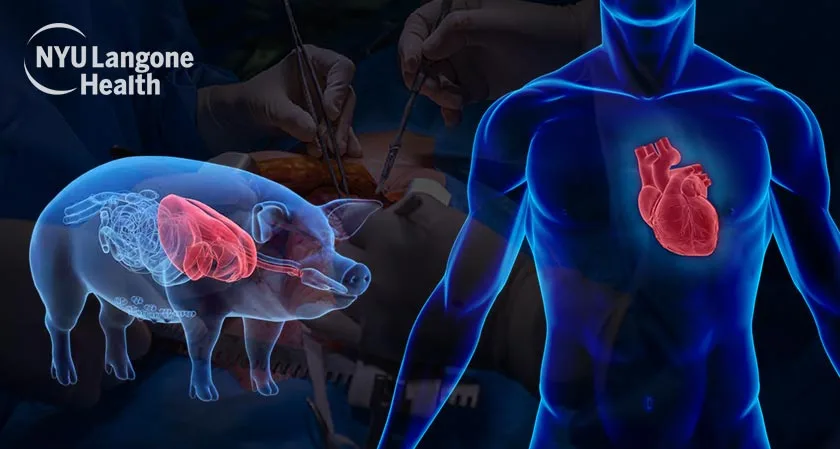 Successful Transplantation