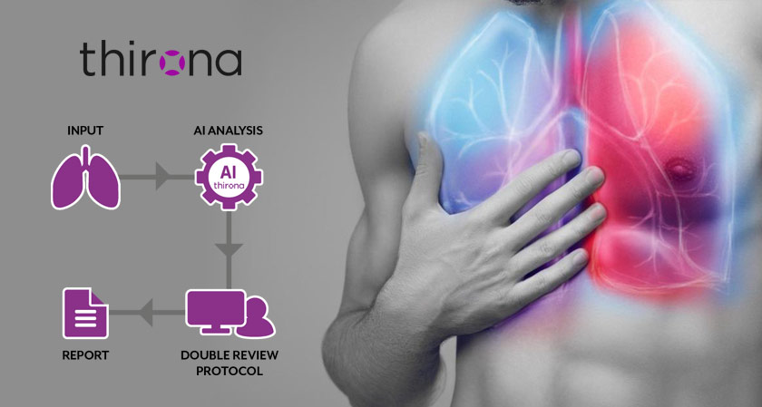 Thirona launches new LungQ software to analyze CF airway problems speedily